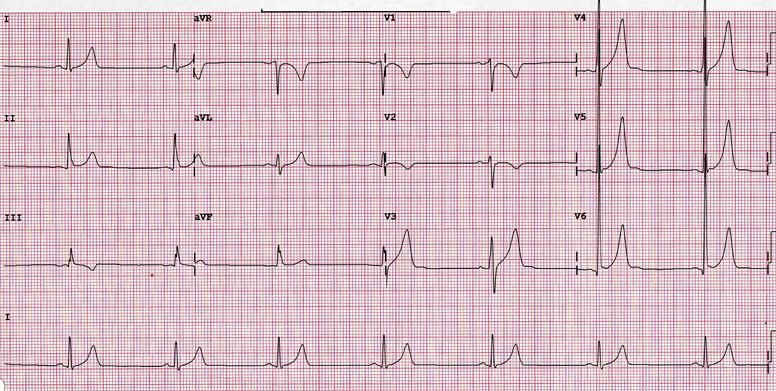 What s A Normal Heart Rate 