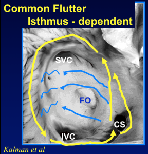 flutter in chest right side
